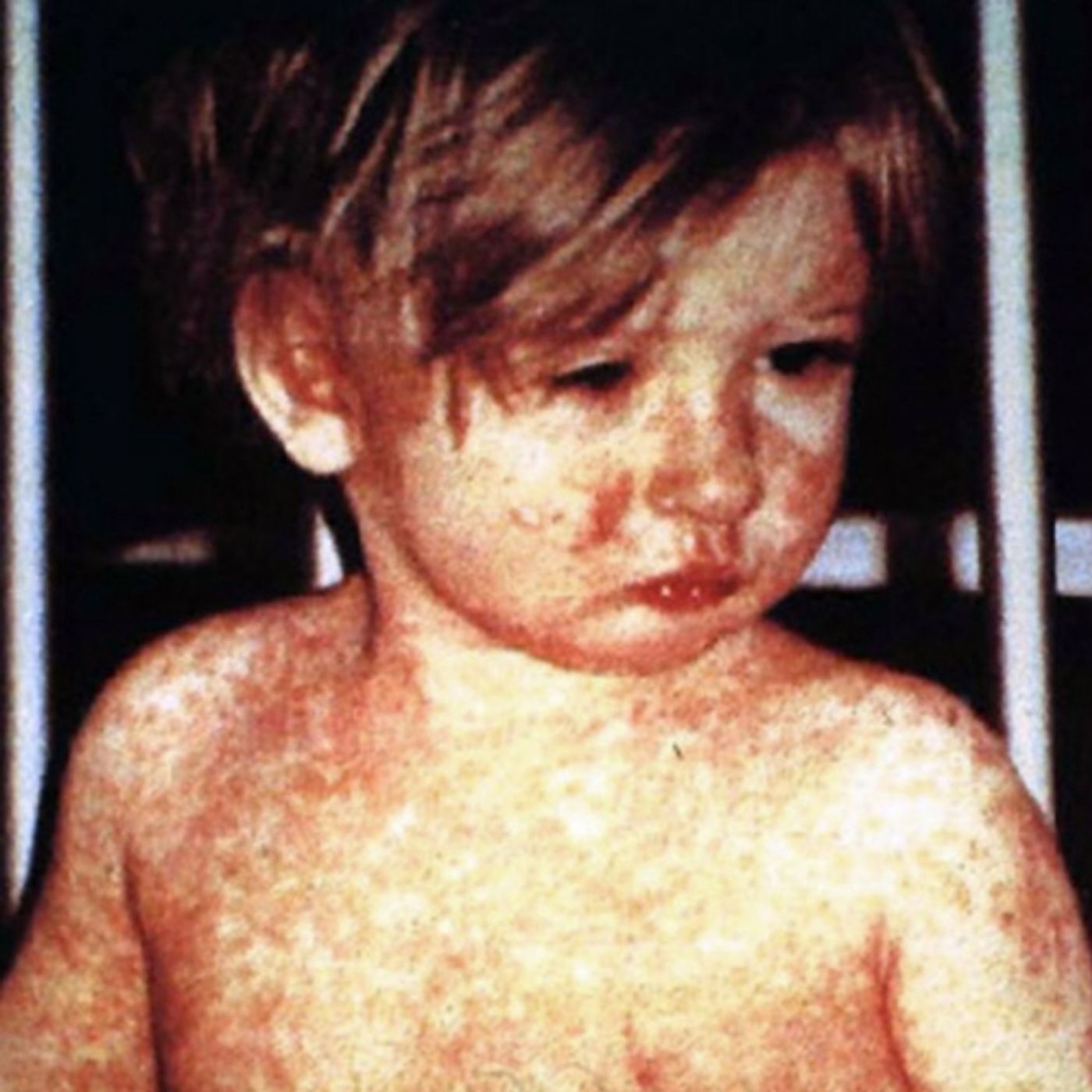 Photo Credit: CDC/NIP/Barbara Rice via Wikipedia