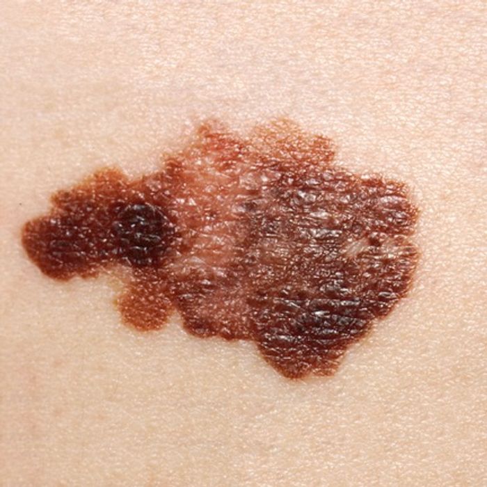 Melanoma is the deadliest form of skin cancer.
