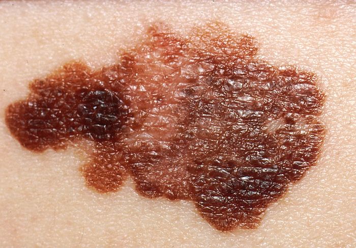 Melanoma on the skin. Image credit: National Cancer Institute