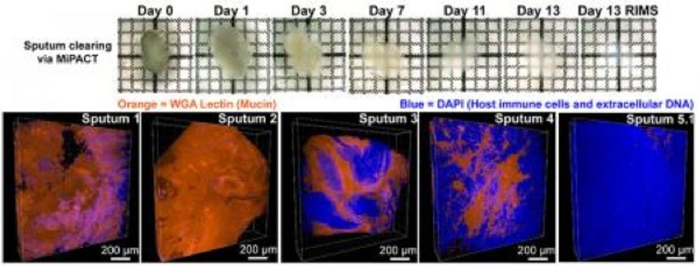 In the MiPACT protocol, fixed and embedded sputum samples are cleared in SDS detergent and incubated in refractive index matching solution (RIMS) for visualization. WGA lectin staining for mucin (orange) and DAPI (blue) shows sputum samples from different patients vary in composition./Credit: Gradinaru and Newman Laboratories/Caltech