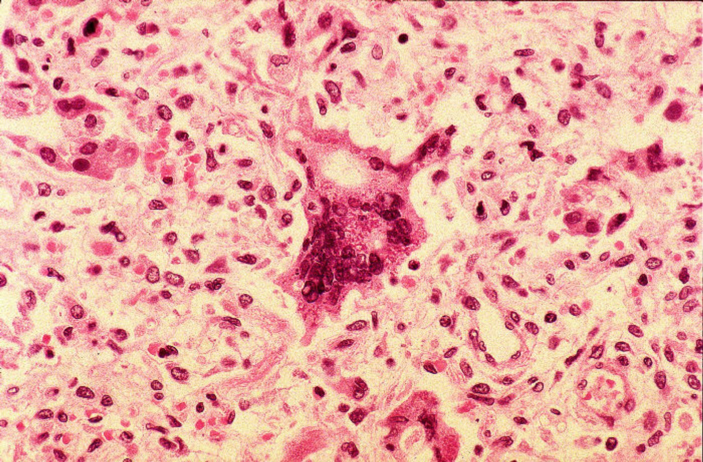 Histopathology of measles pneumonia. Credit: CDC