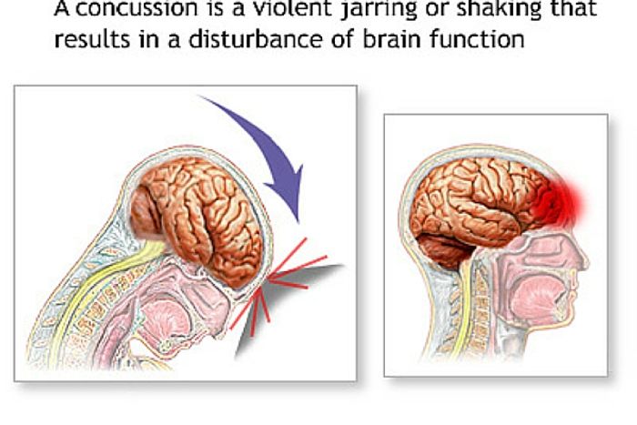 Did NFL officials meddle in concussion research?