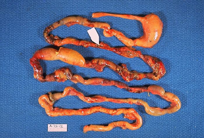 Intestines damaged by necrotizing enterocolitis.
