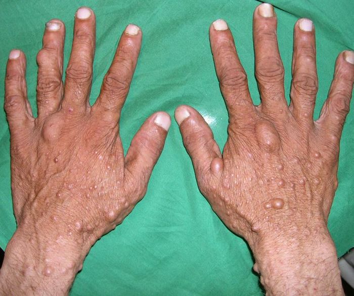 Skin lesions common in cases of neurofibromatosis