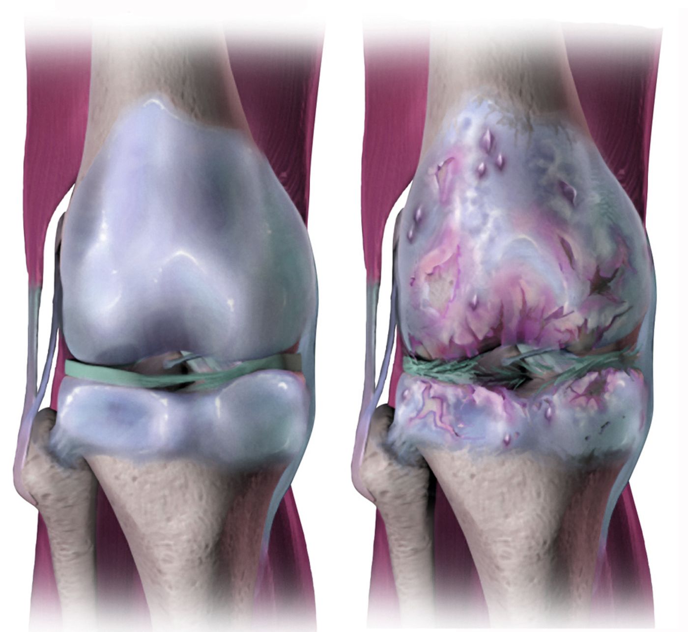 A rendering of a joint affected by osteoarthritis. Credit: Bruce Blaus