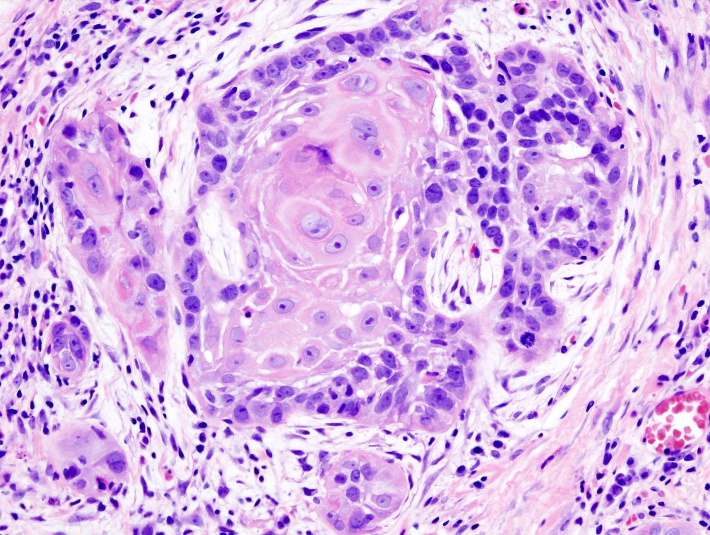 Biopsy of a highly differentiated squamous cell carcinoma of the mouth.