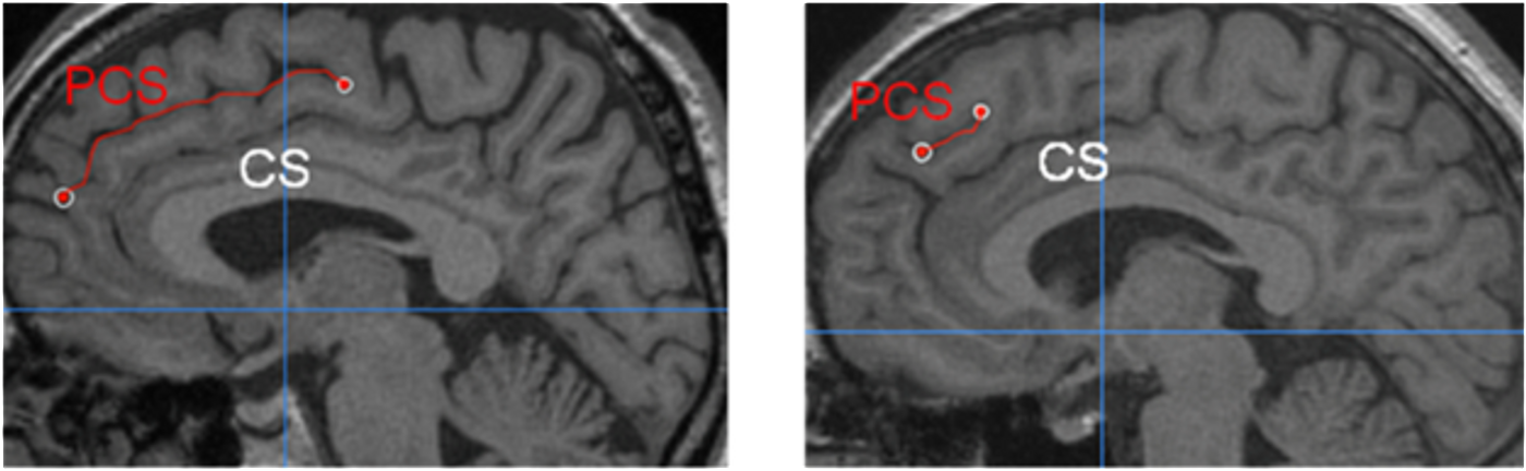 Different length of the paracingulate sulcus (PCS) relative to the corpus callosum (CS).