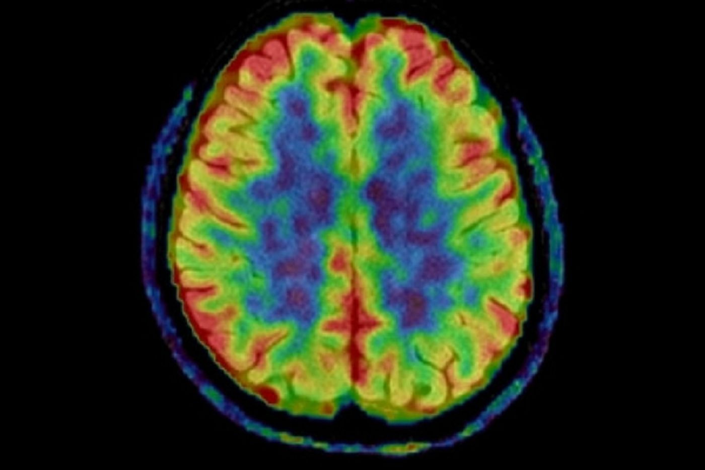 An imaging agent reveals CTE patterns in the brain