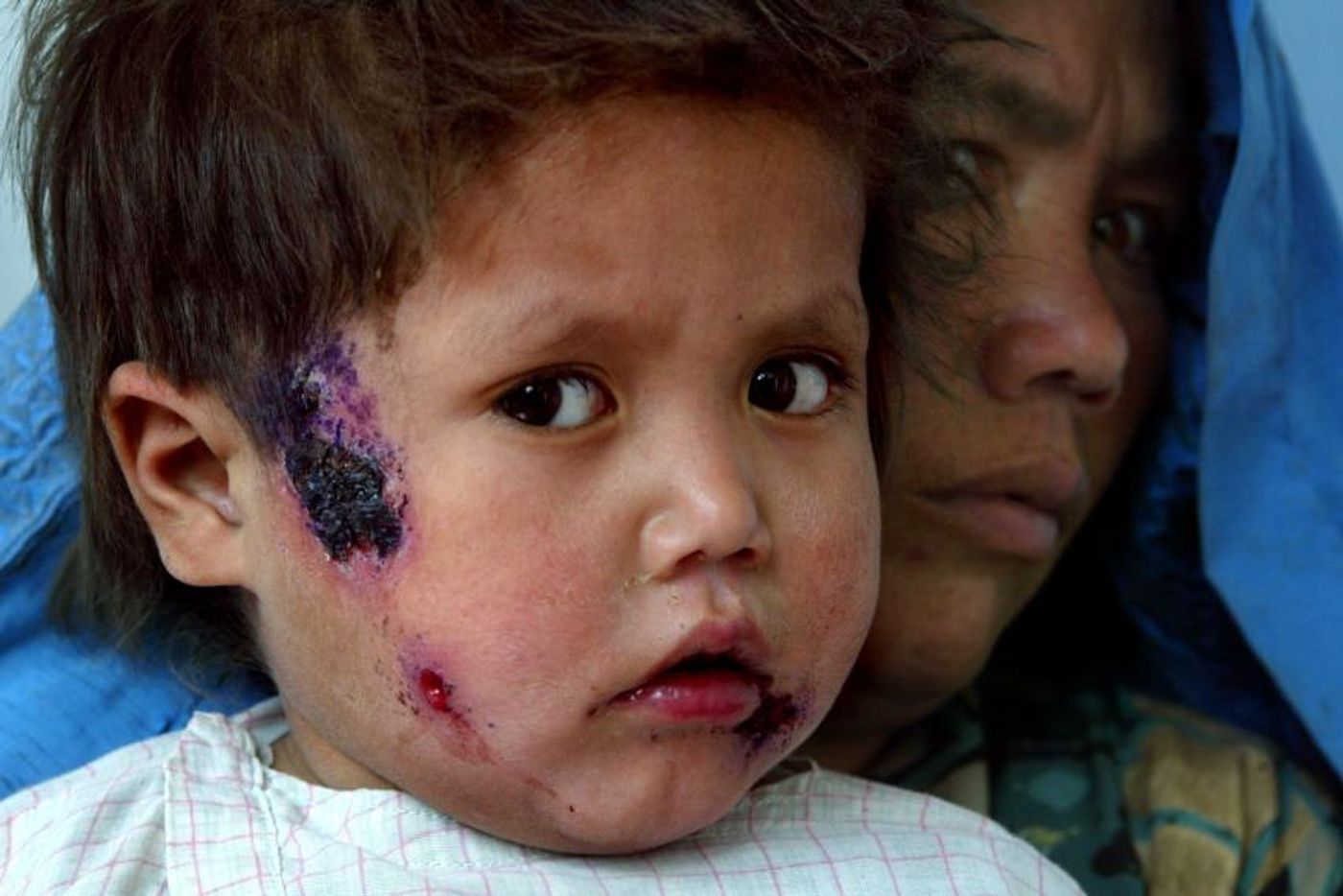 A child with leishmaniasis