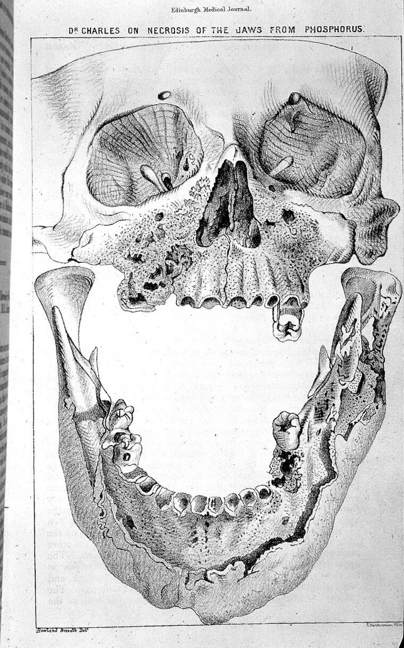 Skull with jaw affected by phosphorus poisoning. J. Bartholomew. Public Domain, Wellcome Collection.