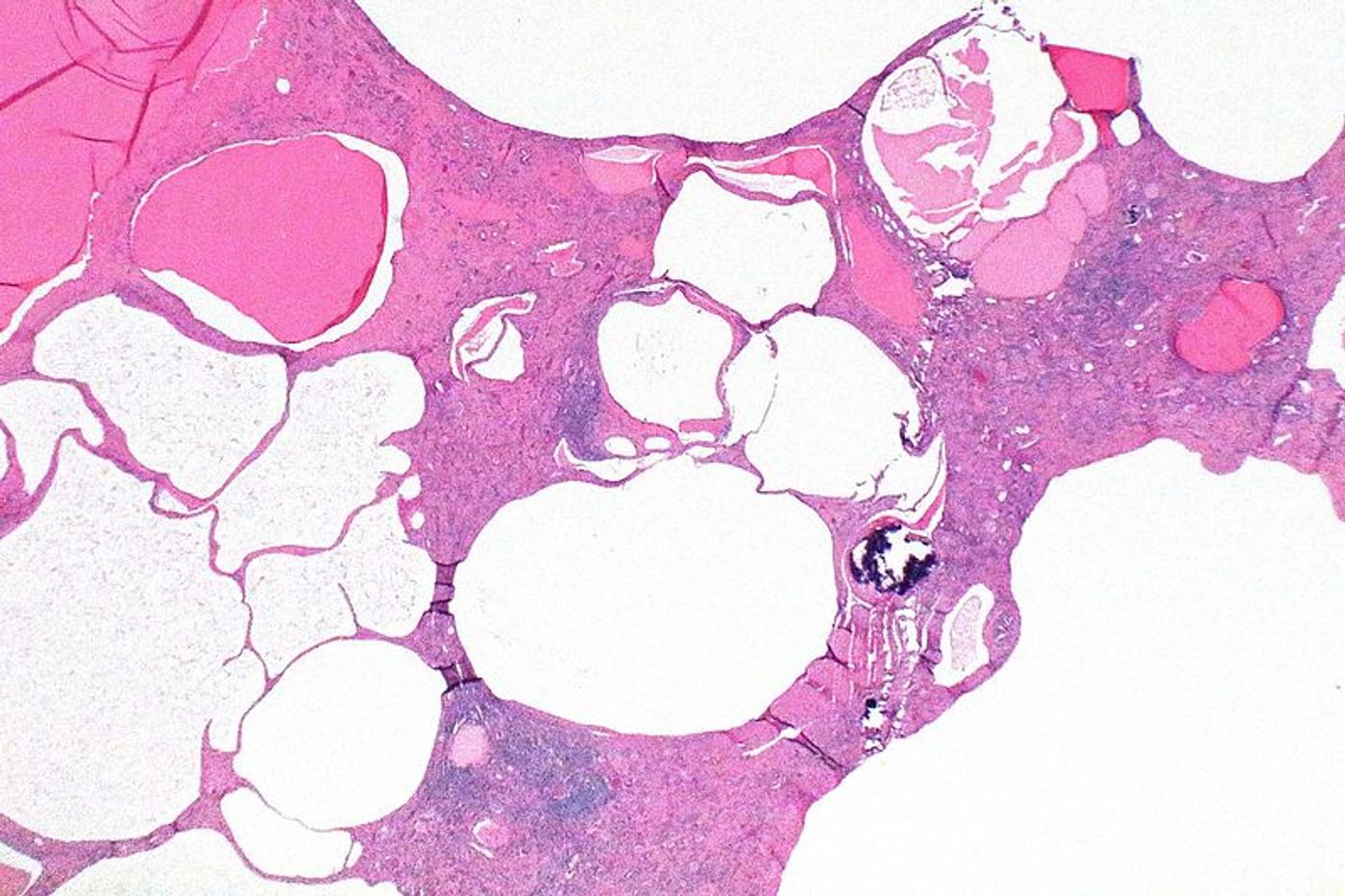 A micrograph showing a type of kidney disease that is inherited, called polycystic kidney disease. Credit: Wikimedia user Nephron