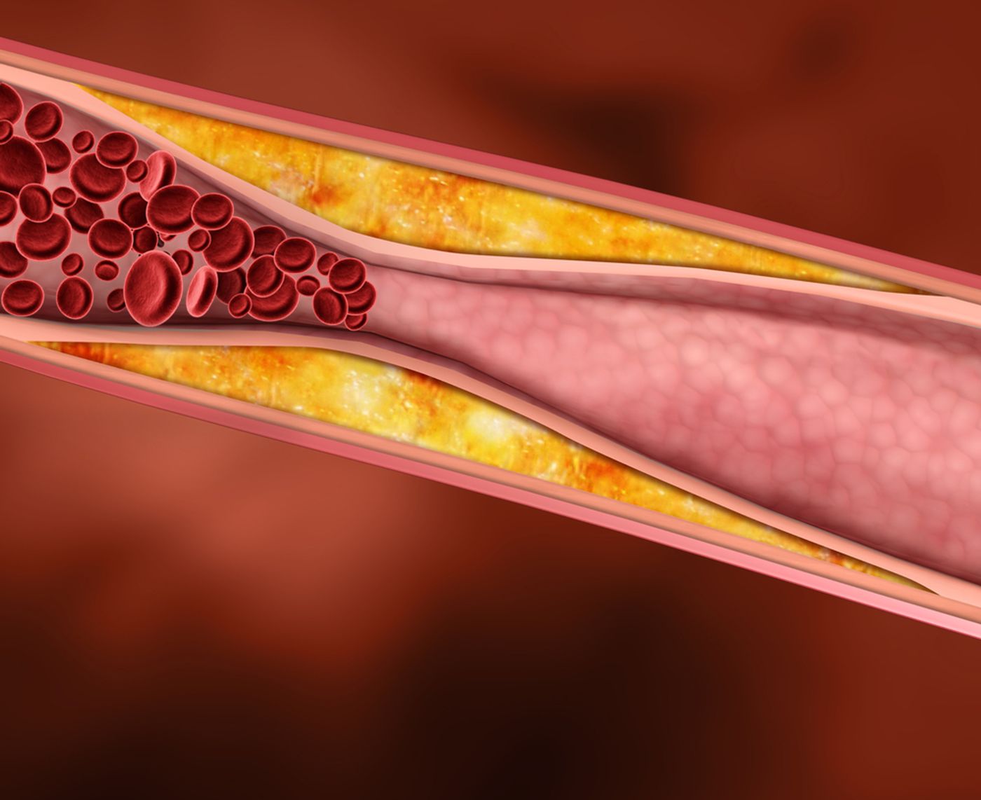 Plaque buildup disrupting blood flow