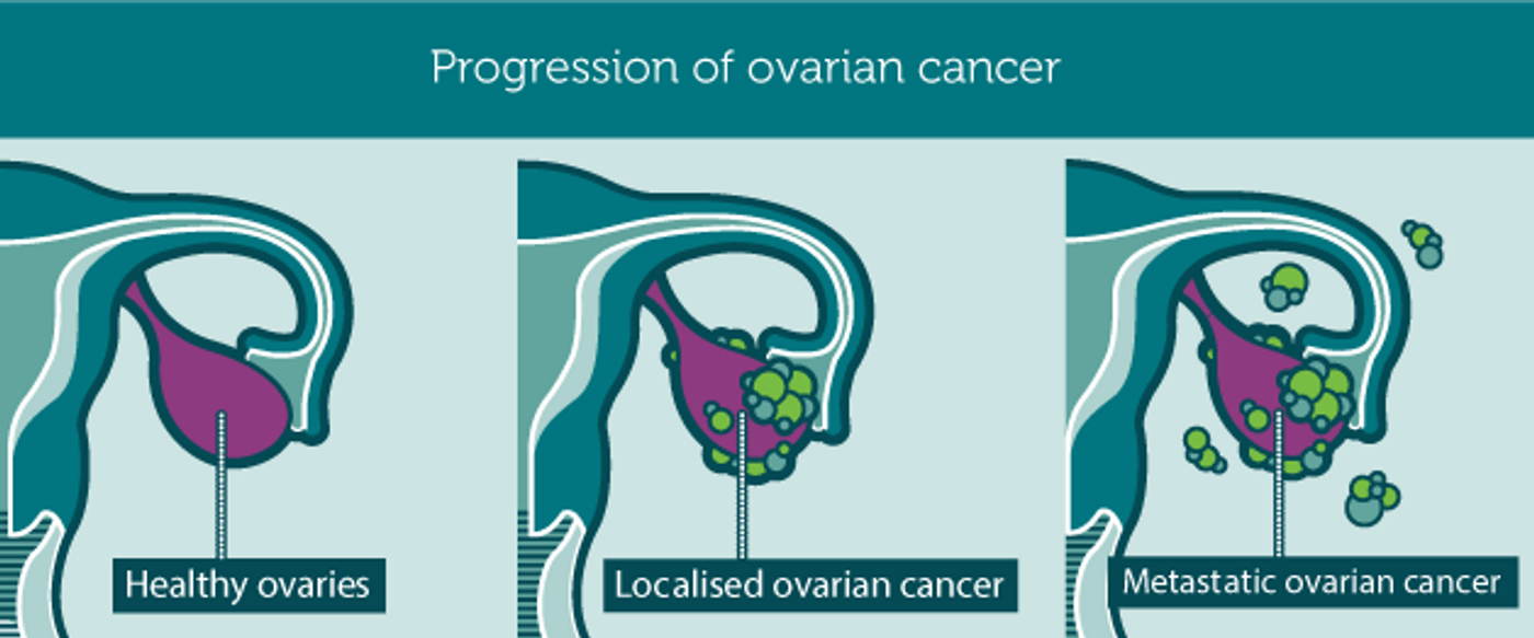 Credit: ovariancancerday.org