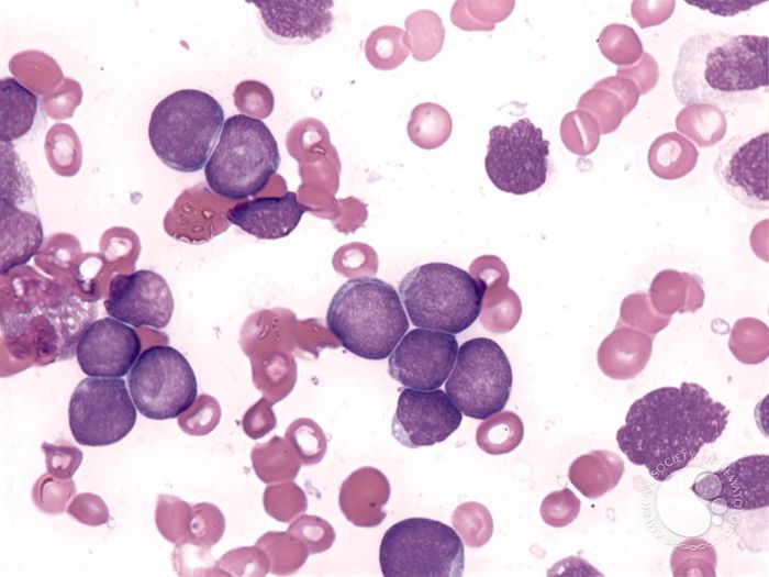 Pre-cursor B-cell Acute Lymphoblastic Leukemia