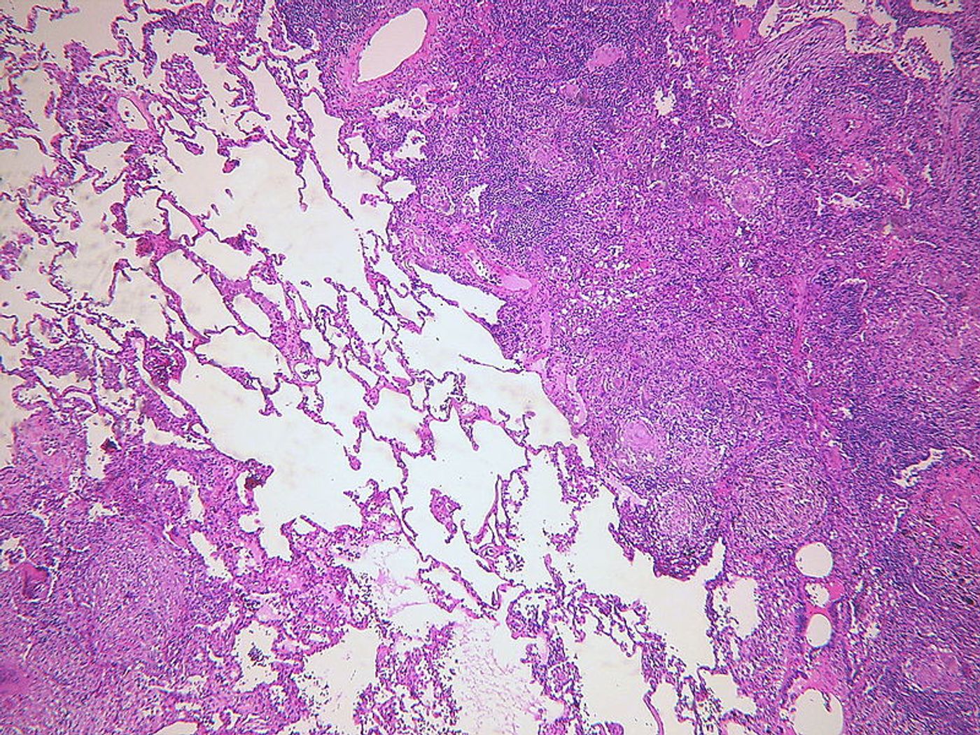 Histopathology of pulmonary tuberculosis. Credit: Yale Rosen