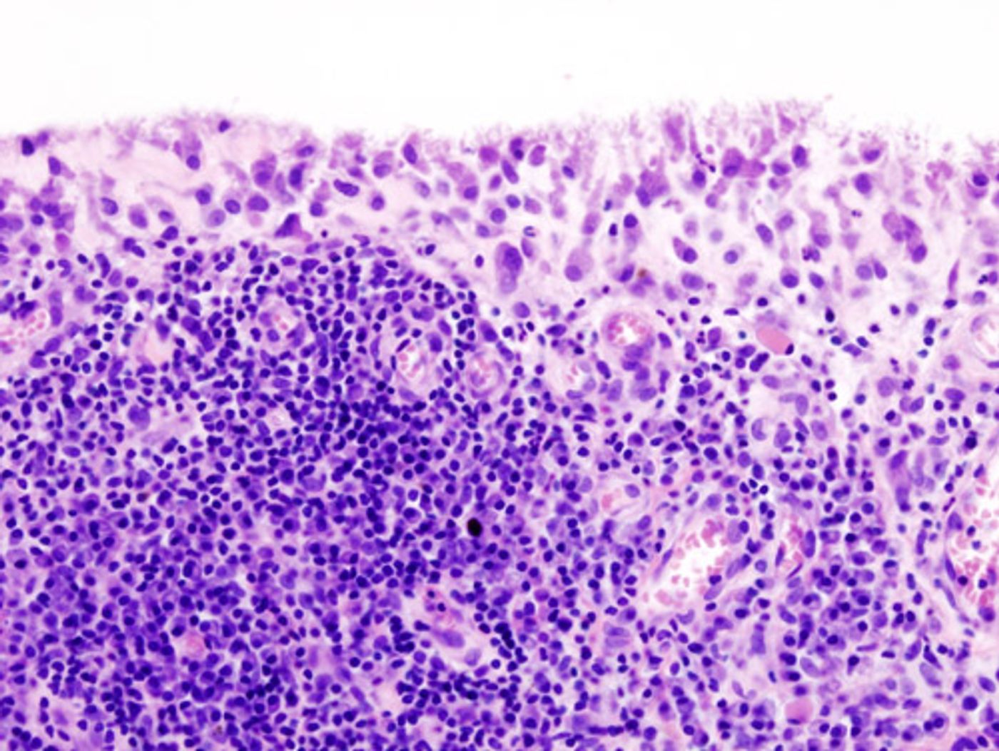 Histopathology of chronic synovitis of the knee joint in a patient with rheumatoid arthritis. Credit: Wikimedia Commons User KGH