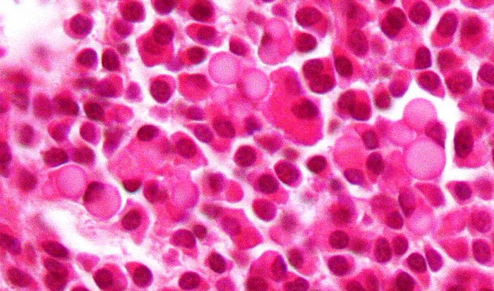 Abundant (malignant) plasma cells in multiple myeloma. Credit: Wikimedia user Nephron