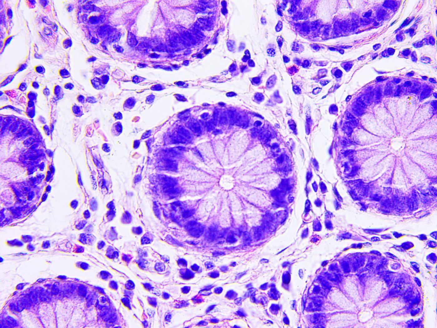 Colon cancer cells / Credit: Sanford Burnham Prebys Medical Discovery Institute