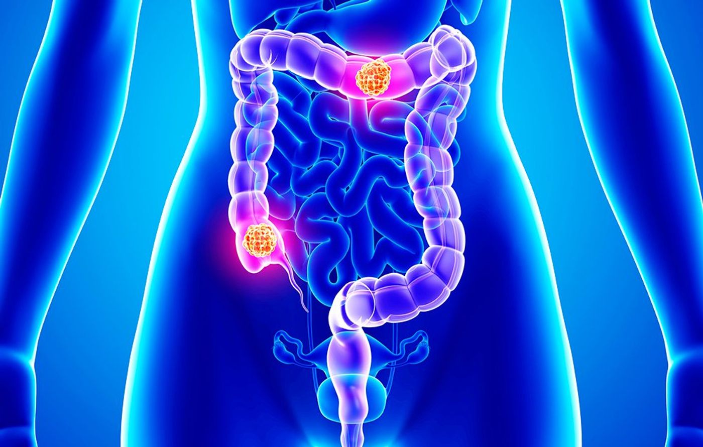 S. gallolyticus promotes colon cancer. 