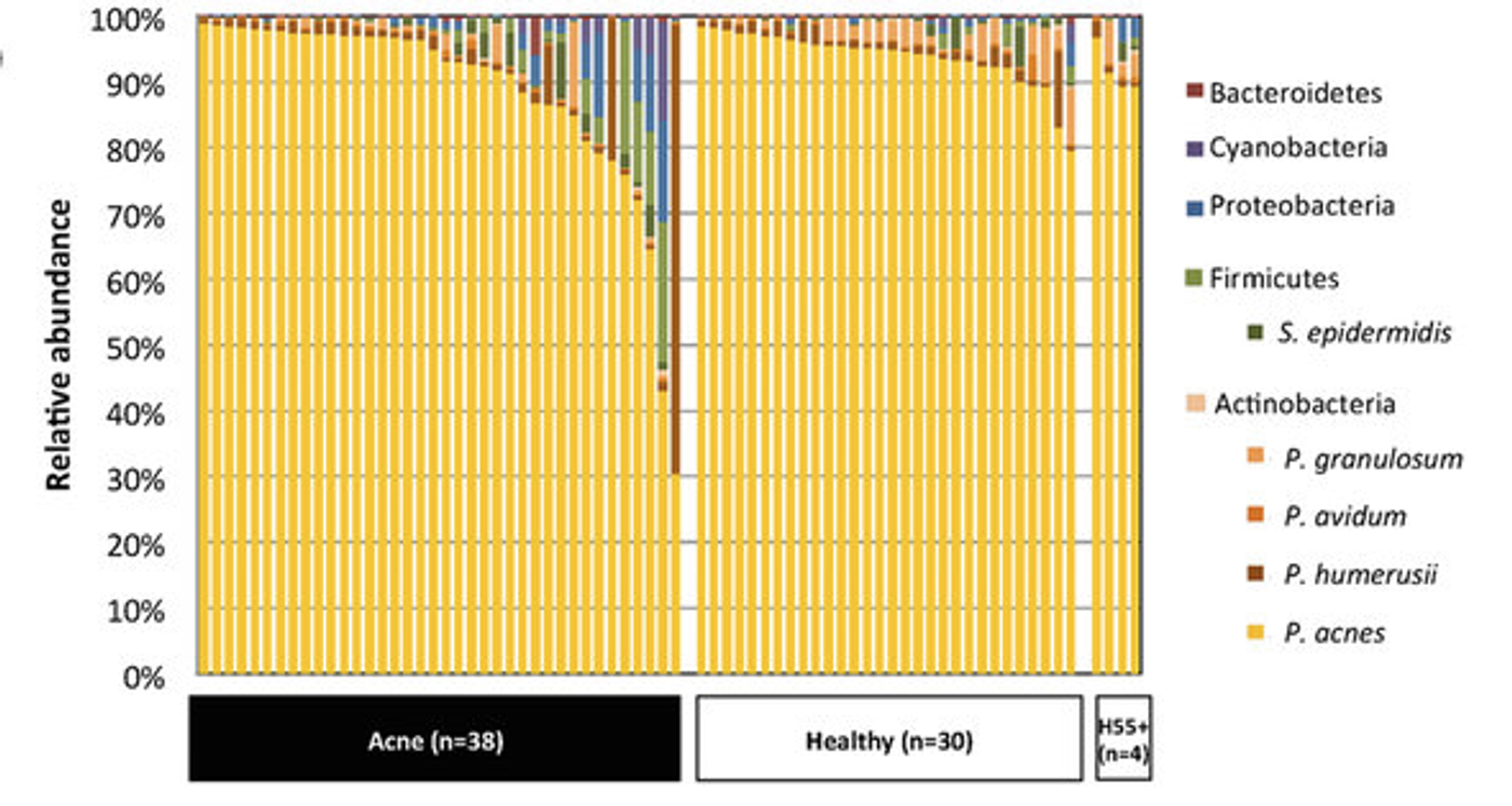 Each column shows the relative abundances of the bacterial species found in each individual. P. acnes was the dominant skin bacterium in all samples but one. P. acnes avg: 91% of the bacteria, levels of P. acnes and P. granulosum increased in the healthy individuals, while minor taxa increased in the acne group. / Credit: Scientific Reports 2017 Barnard et al 