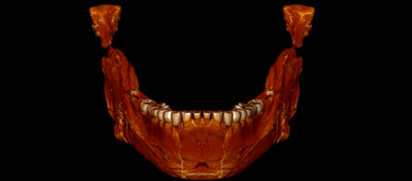 A reconstruction of the mandible from the 300,000+ year-old fossil found in Morocco.