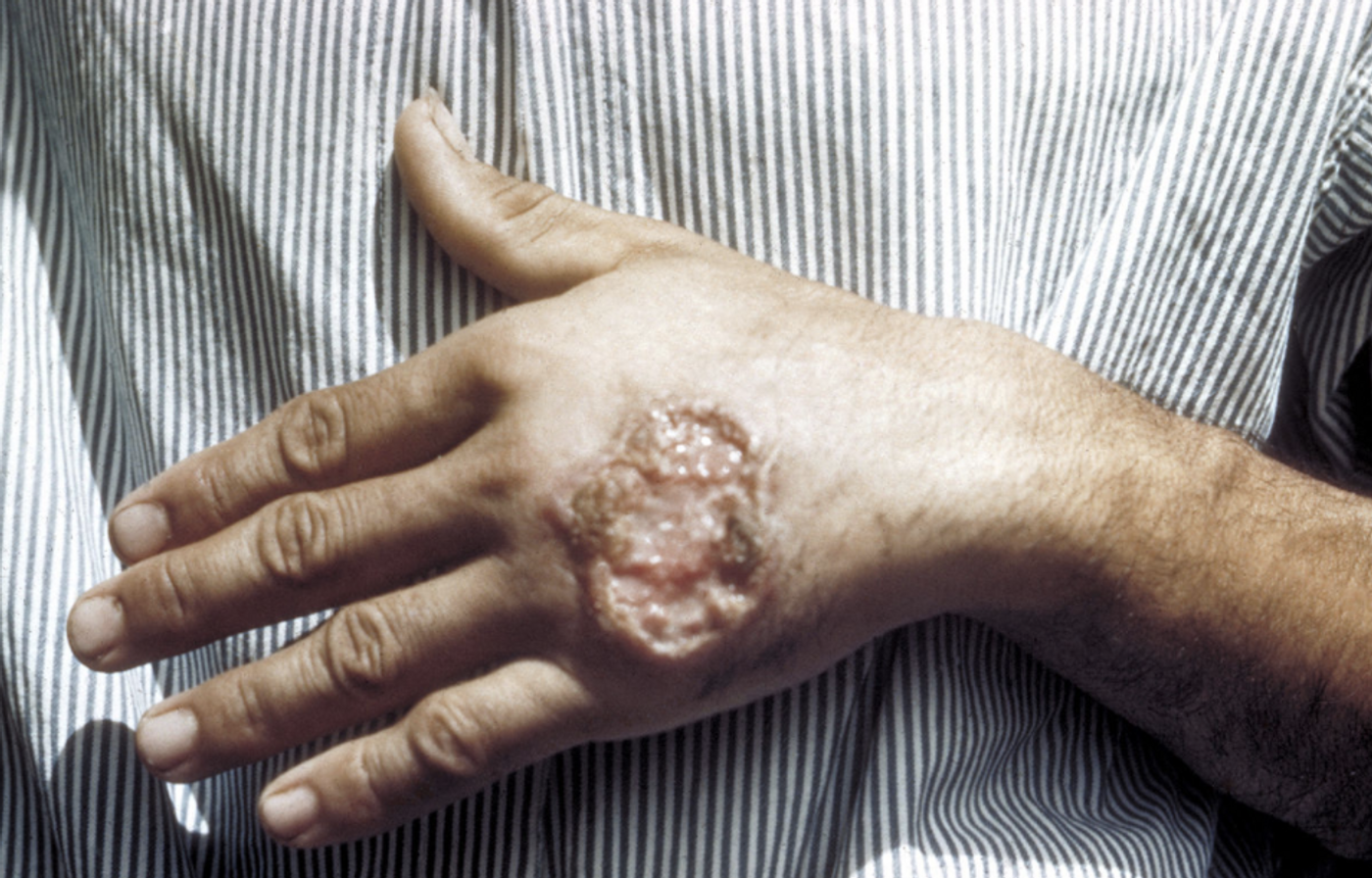 Skin ulcer due to leishmaniasis, hand of Central American adult. / Credit: CDC/Dr. D.S. Martin
