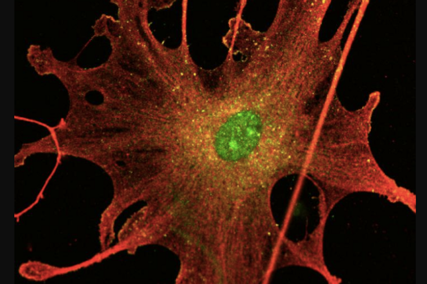 This is a schwannoma tumor cell. / Credit: University of Plymouth