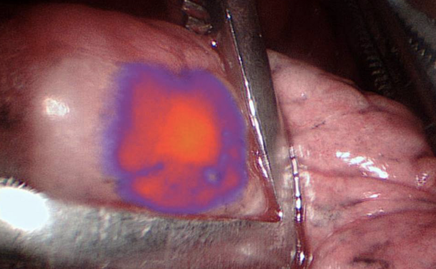 A glowing nodule / Credit: Penn Medicine