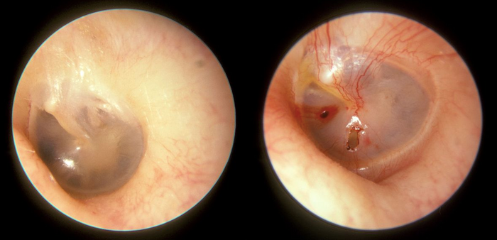 A normal tympanic membrane on the left, and one ruptured four days before the photos was taken on the right. / Credit: Wikimedia/Michael Hawke MD