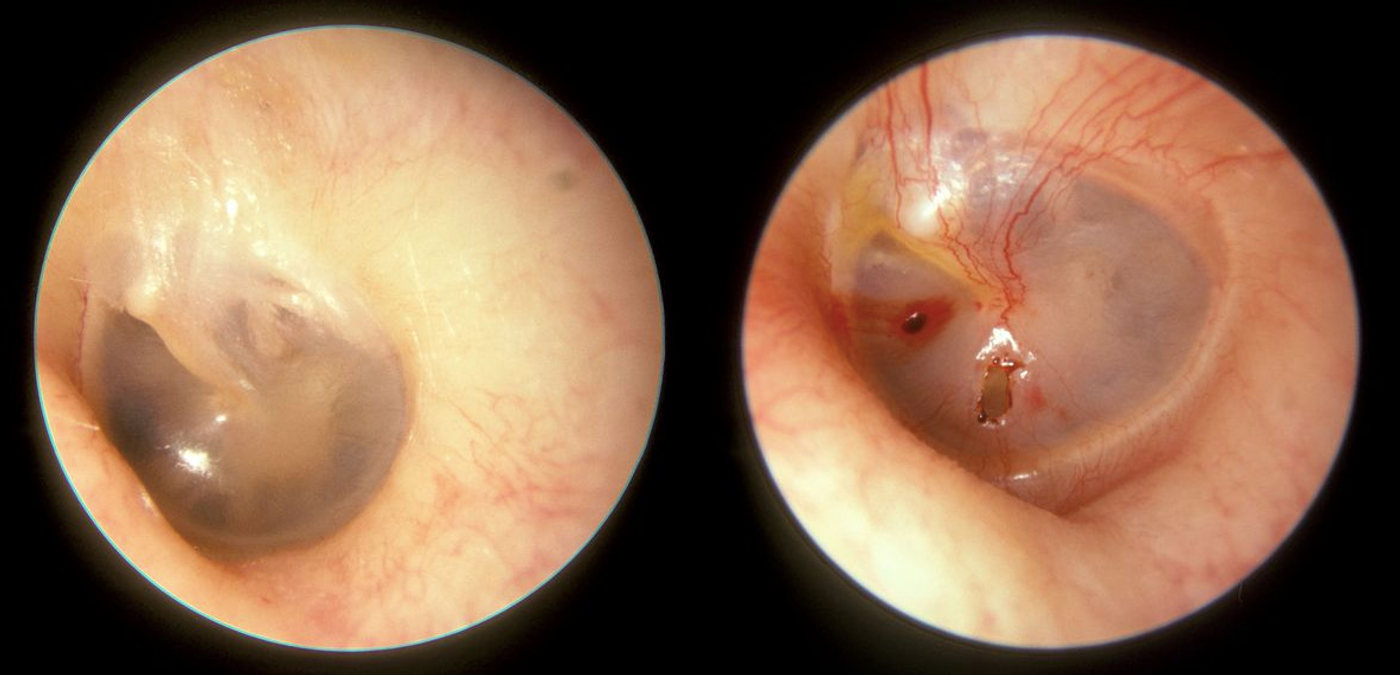 ruptured tympanic membrane