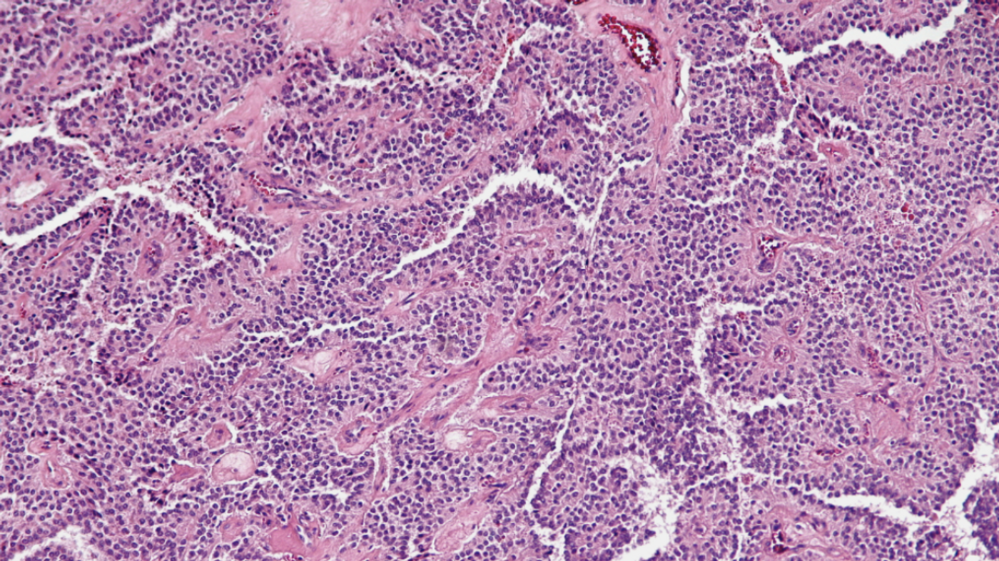 Scientists may have found a new avenue for the development of treatments for solid cancers, like this solid pseudopapillary tumor of the pancreas / Credit: Wikimedia Commons