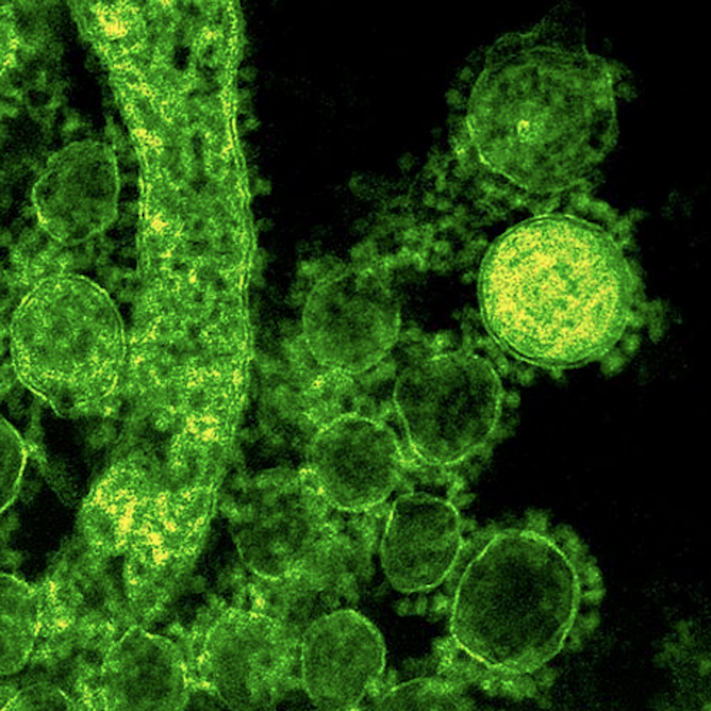 Colorized transmission electron micrograph showing particles of the Middle East respiratory syndrome coronavirus that emerged in 2012. / Credit: NIAID