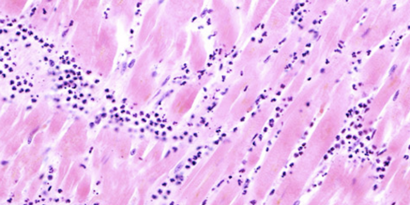 Histopathology of acute myocardial infarction, showing coagulative necrosis of cardiomyocytes. / Credit: Wikimedia Commons