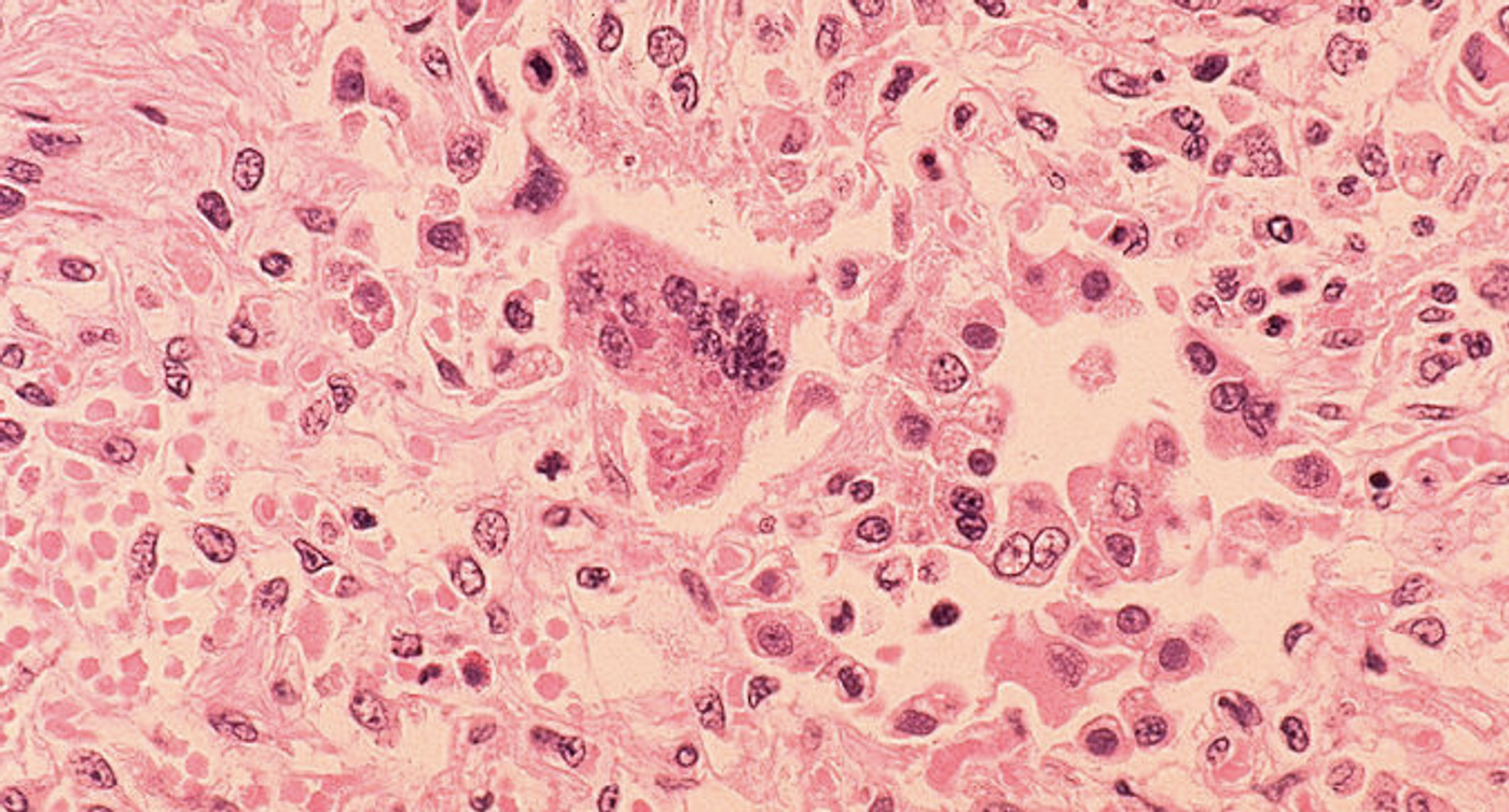 Histopathology of measles pneumonia / Credit:CDC/ Dr. Edwin P. Ewing, Jr.