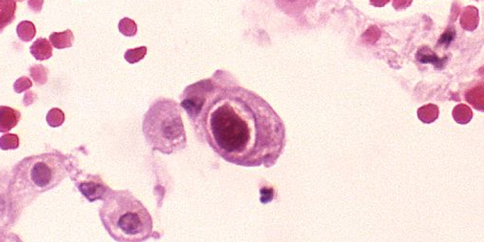 Cytomegalovirus (CMV) infection of a lung pneumocyte / Credit: CDC