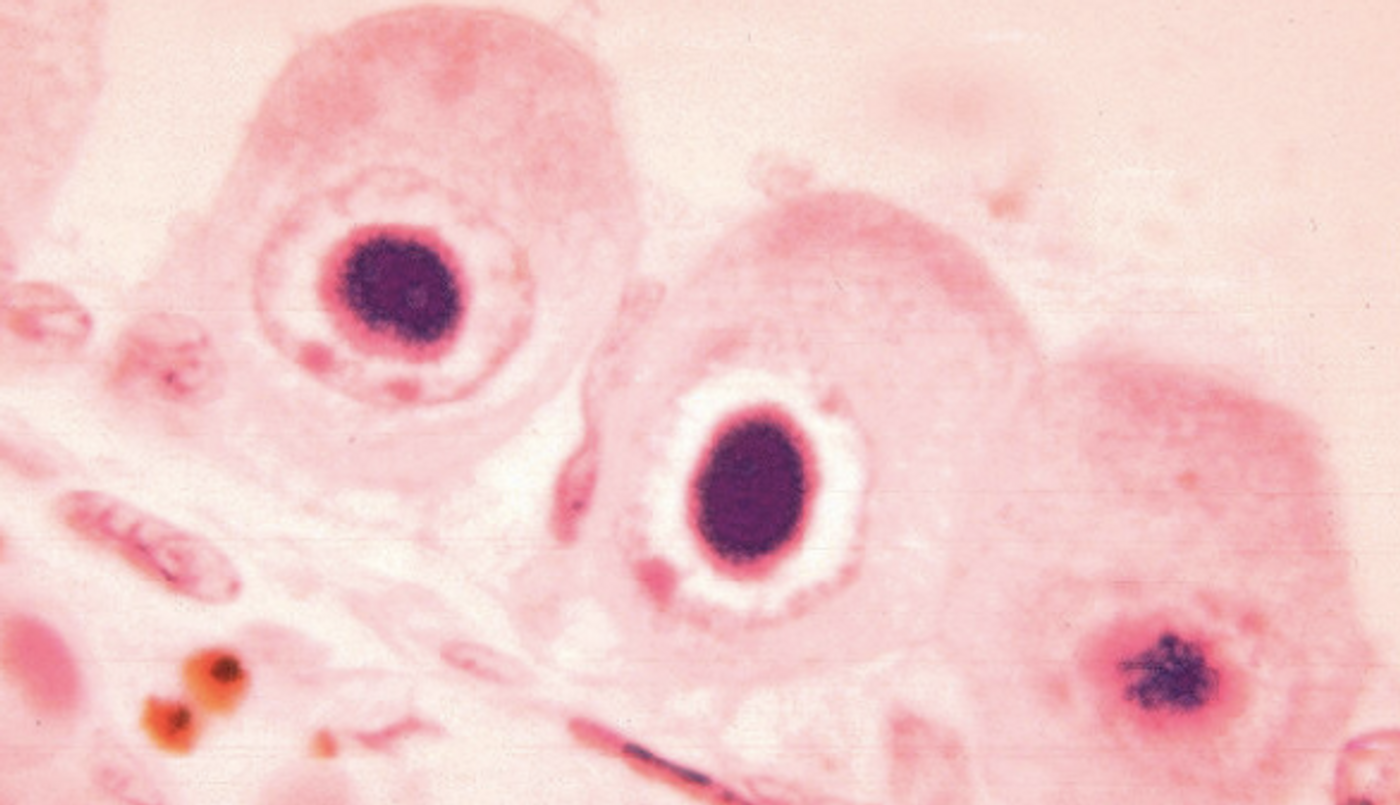 Cytomegalovirus infection of the kidney / Credit: Public Domain FIles