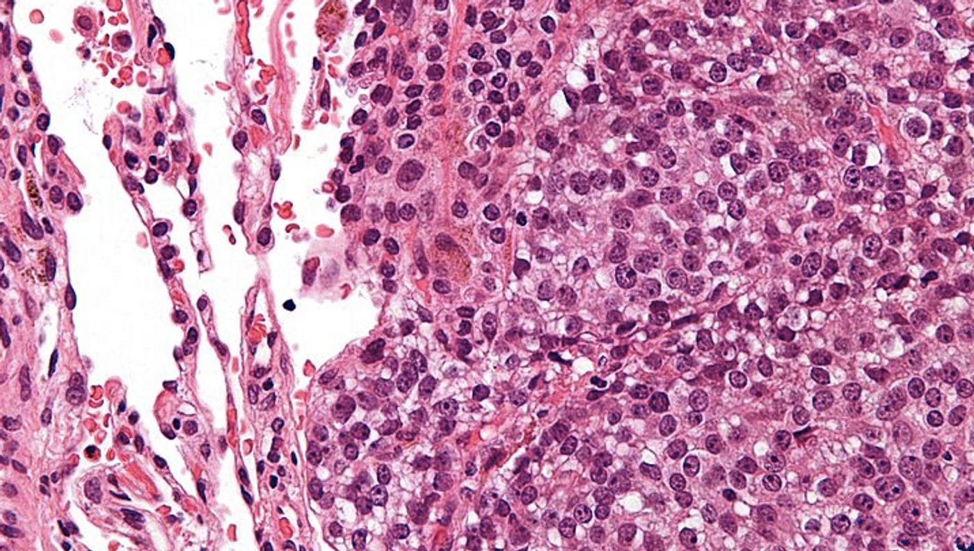 Very high magnification micrograph of Ewing sarcoma in lung. H&E stain / Credit: Nephron/Wikimedia Commons