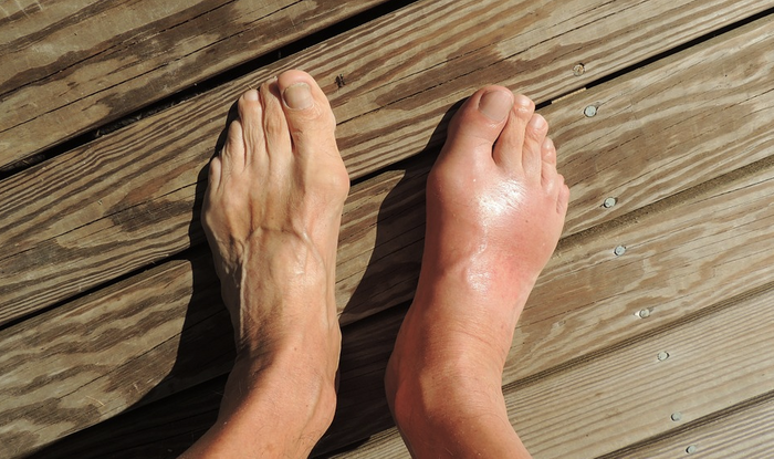 A case of gout / Image credit: Pixabay