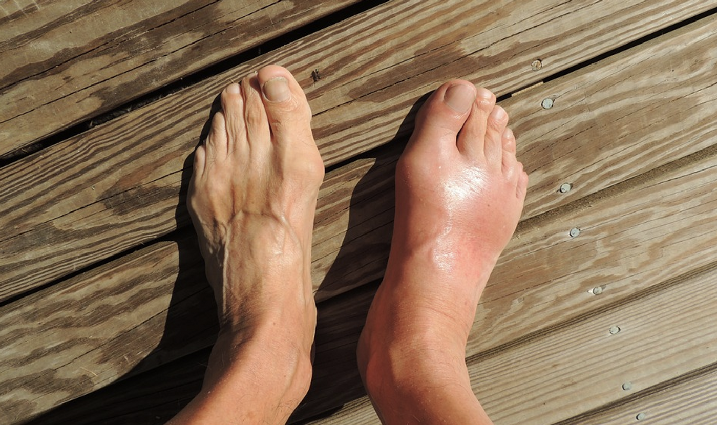 A case of gout / Image credit: Pixabay