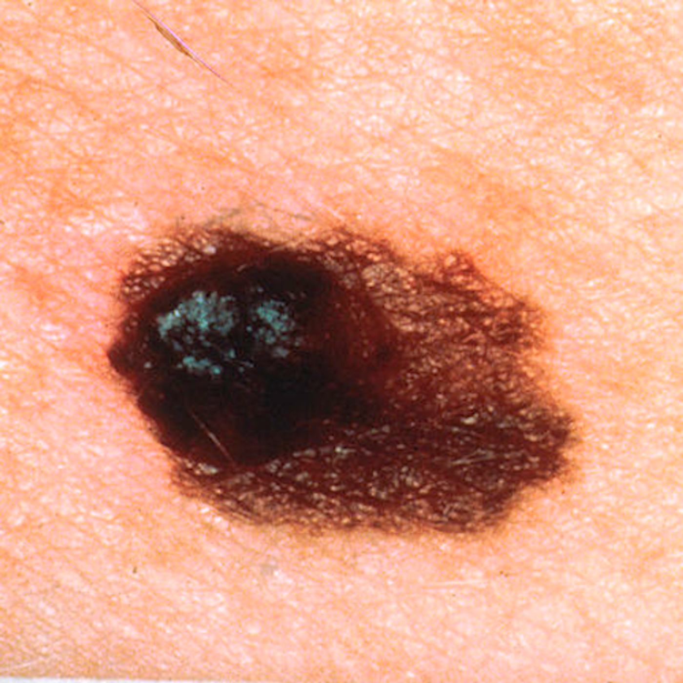 Asymmetrical melanoma, the left side of the lesion is much thicker than the right side. / Credit: Wikimedia Commons/Skin Cancer Foundation