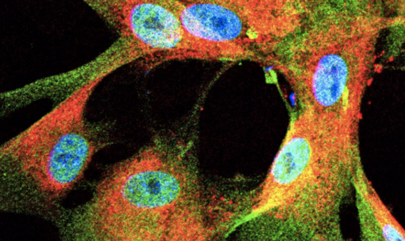 This microscopic image uses immunostaining to highlight the presence of TAZ/YAP (shown in green) in human malignant peripheral nerve sheath tumors that grew from Schwann cells. The job of Schwann cells is to form the protective nerve sheath. The cell nuclei are shown in blue. / Credit: Cincinnati Children's
