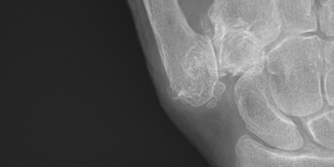 Stage 4 trapeziometacarpal osteoarthritis, with major subluxation of the joint./ Credit: Wikimedia Commons/Mikael Häggström