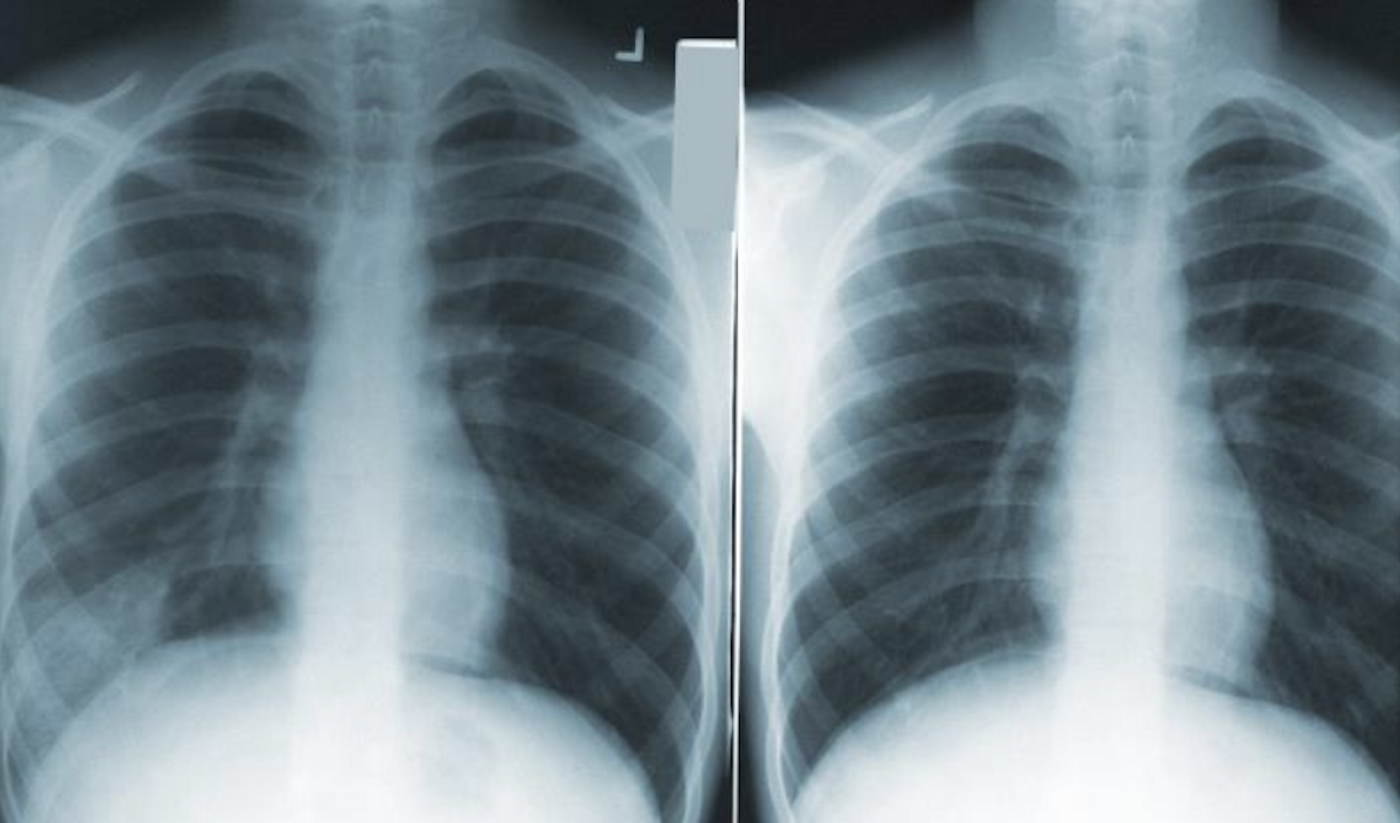 This image depicts two anteroposterior (AP) chest x-rays/ Credit: CDC/ H. Bruce Dull, M.D.