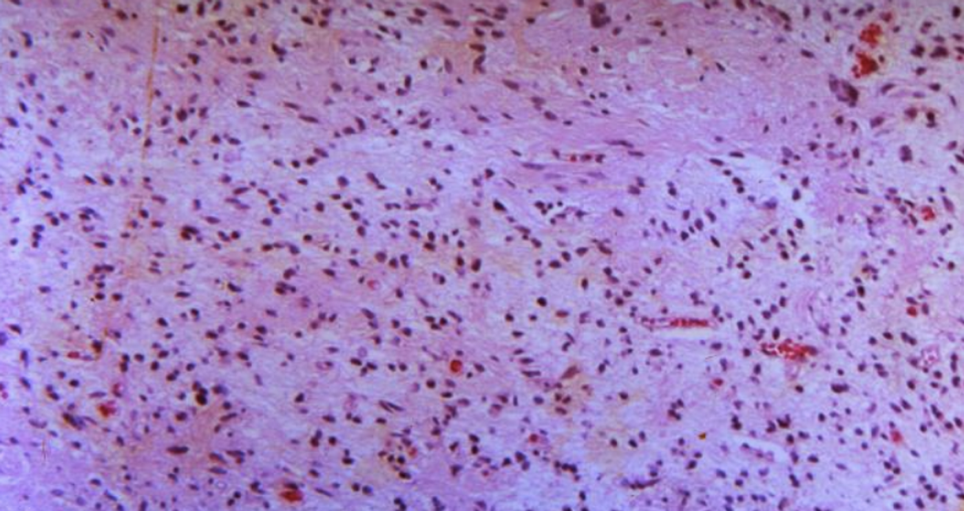 A human brain tissue biopsy specimen with different cell types / Credit: CDC / R.D. Kimbrough