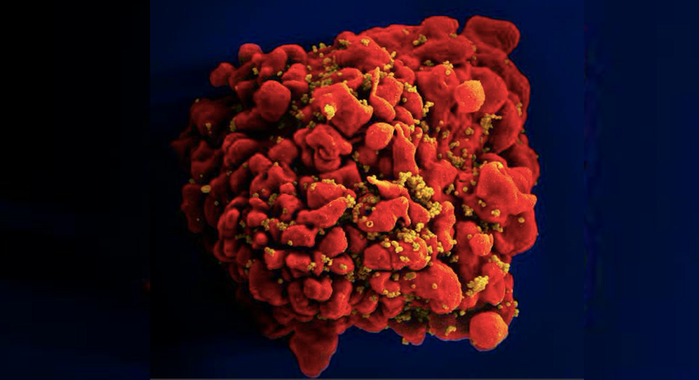 An SEM image of a single, red-colored, H9-T cell infected by numerous, spheroid shaped, mustard-colored human immunodeficiency virus (HIV) particles, seen attached to the cell's surface membrane./ Credit: National Institute of Allergy and Infectious Diseases (NIAID)