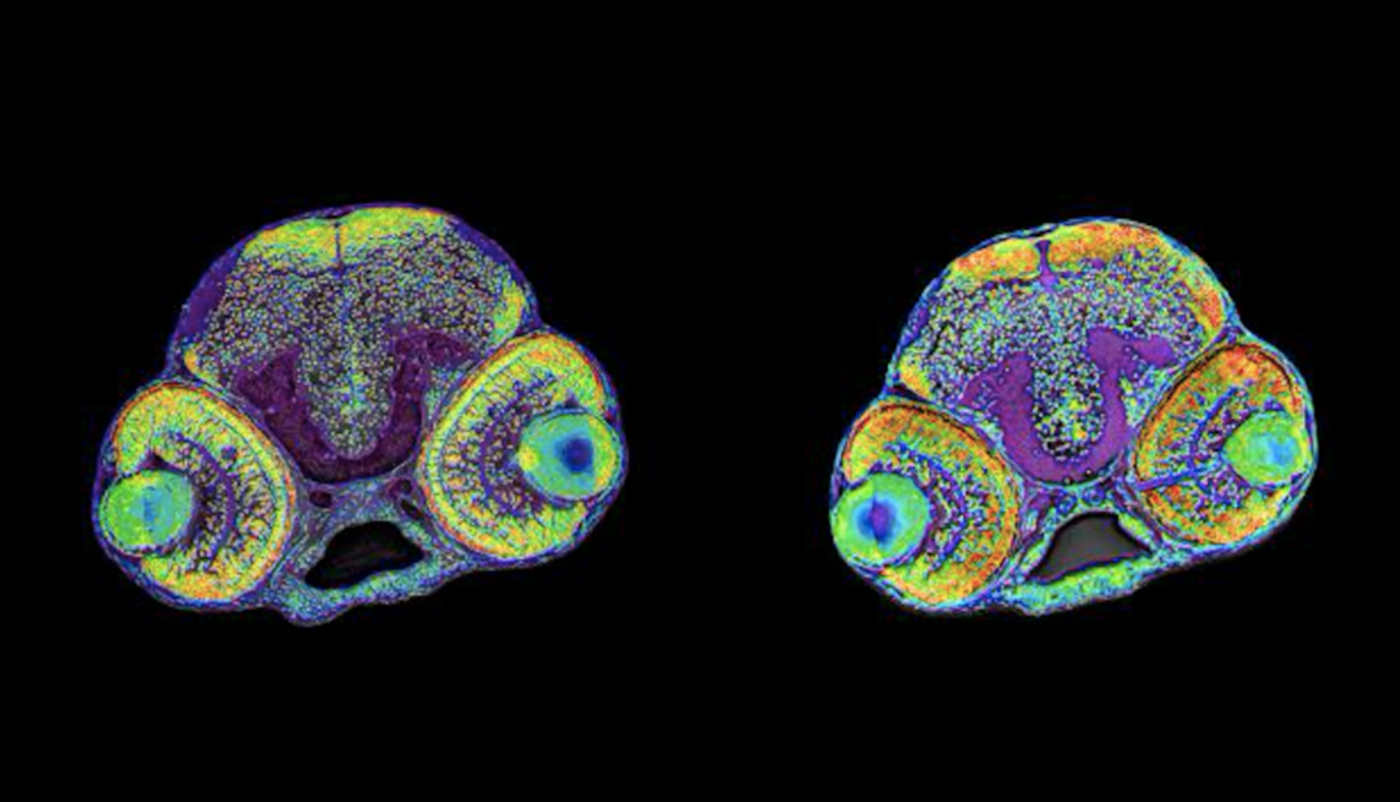 The picture shows the brain of a normal zebrafish larvae (left) and a larvae with microcephaly (right). / Credit: Assist.Prof. Canan Doganli, University of Copenhagen