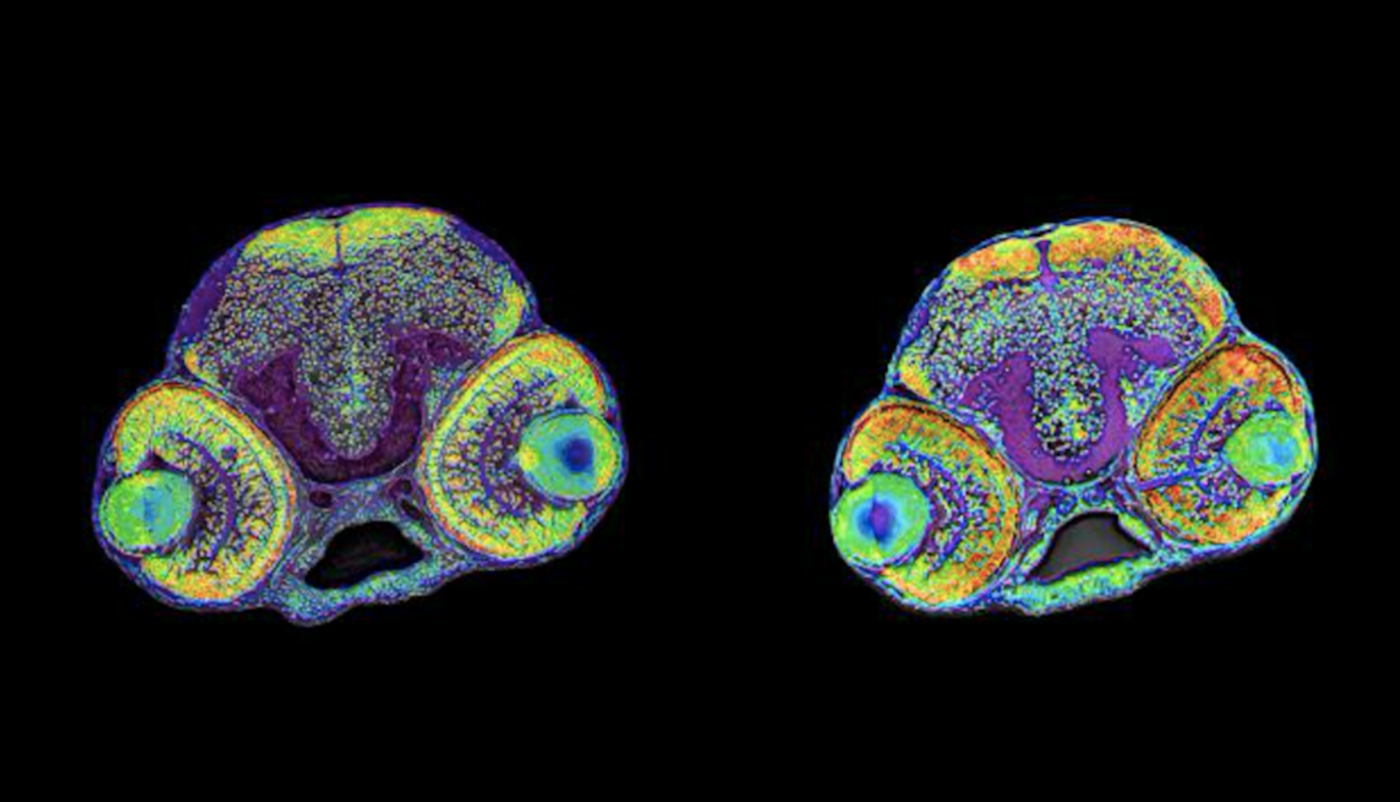 Why Mutations in RRP7 Cause a Congenital Brain Disorder | Genetics And ...