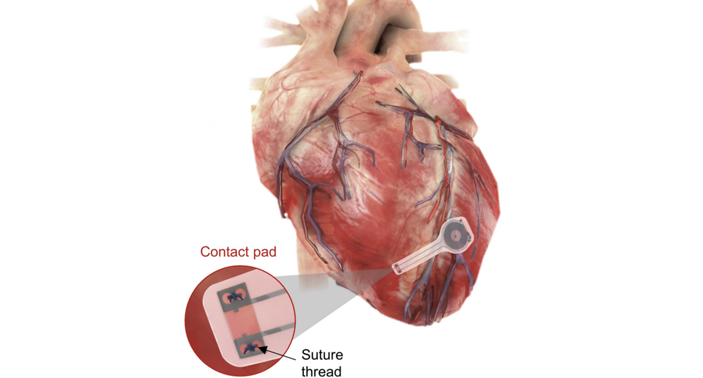 An illustration of the transient pacemaker mounted on myocardial tissue./ Credit: Northwestern University/George Washington University