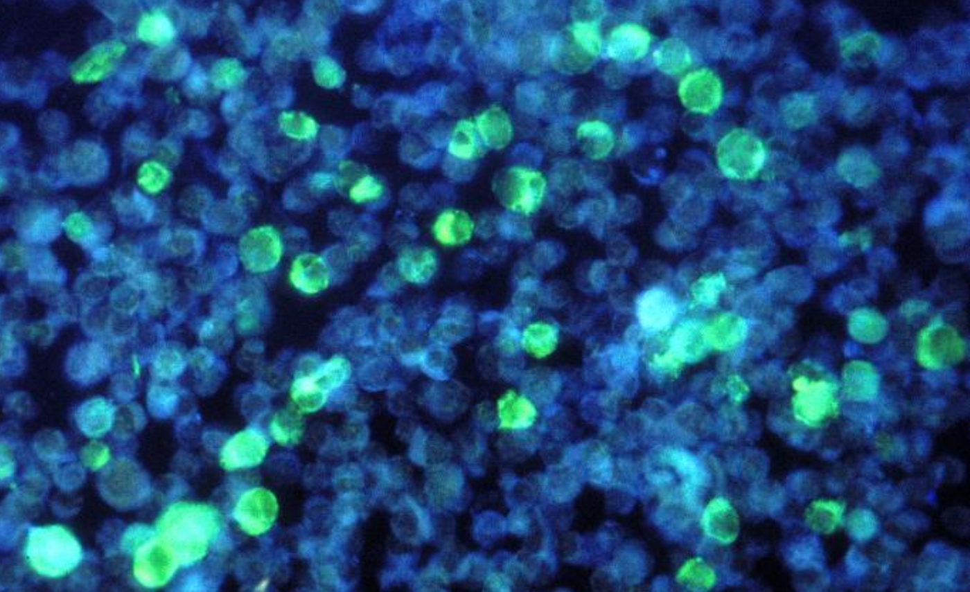 A photomicrograph of leukemia cells that contain Epstein-Barr virus (EBV) / Credit: CDC/ Dr. Paul M. Feorino