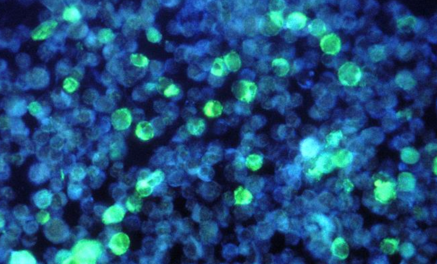 A photomicrograph of leukemia cells hosting Epstein-Barr virus (EBV) / Credit: CDC/ Dr. Paul M. Feorino